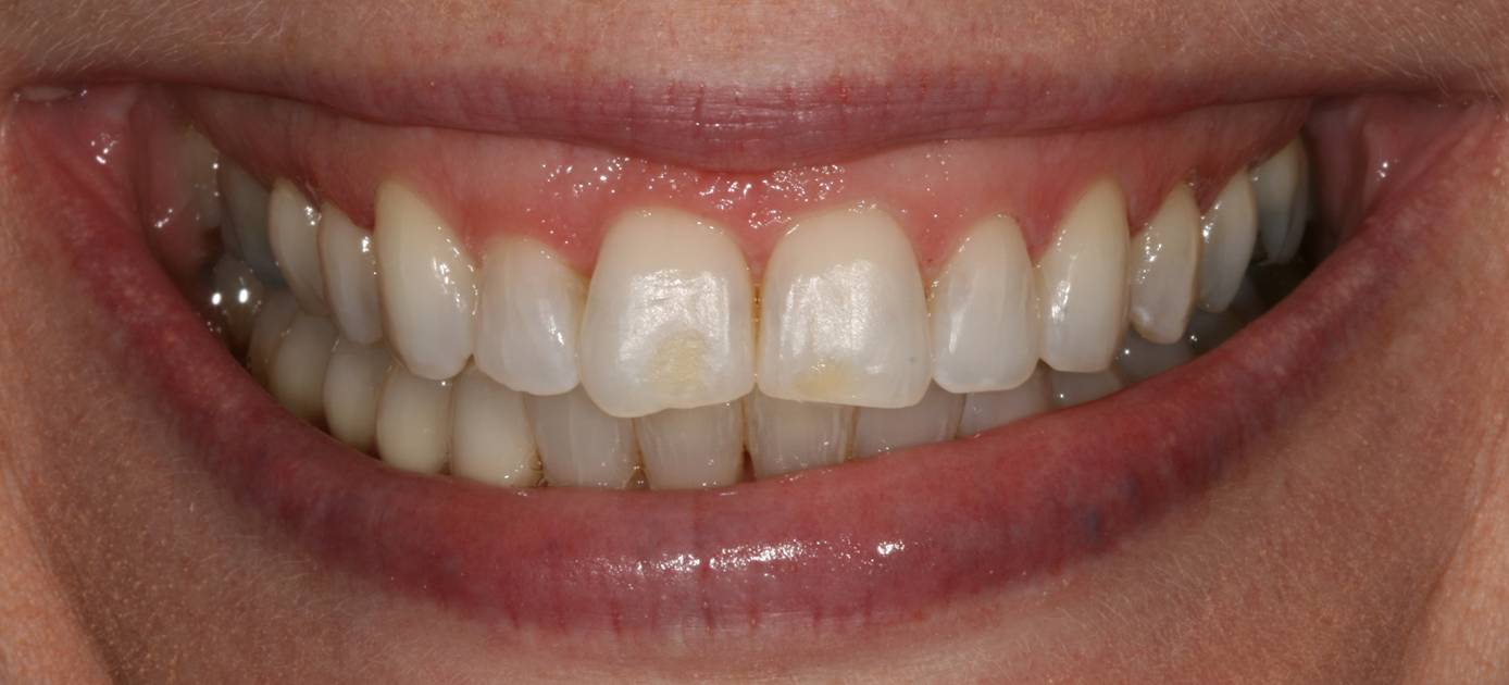 Aesthetic case 1 (crooked, crowded teeth) - before