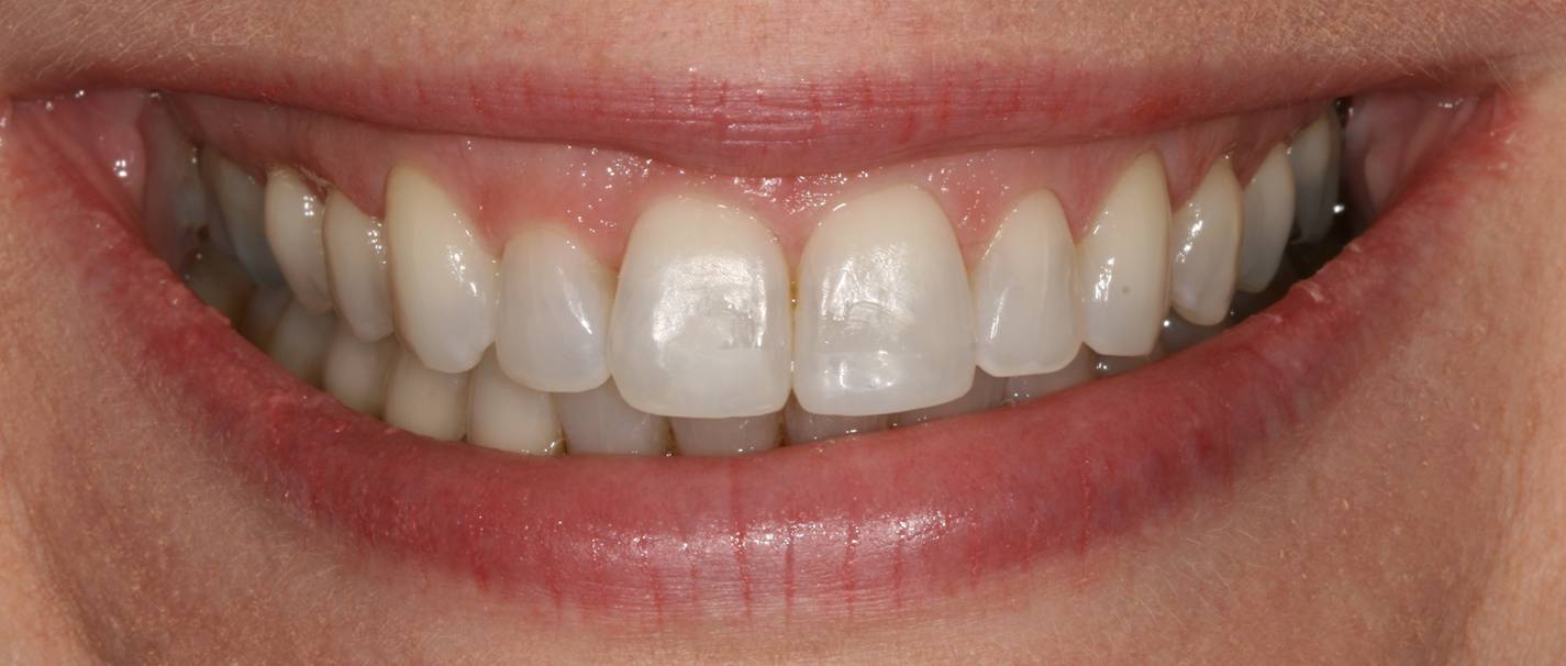 Aesthetic case 1 (crooked, crowded teeth) - after