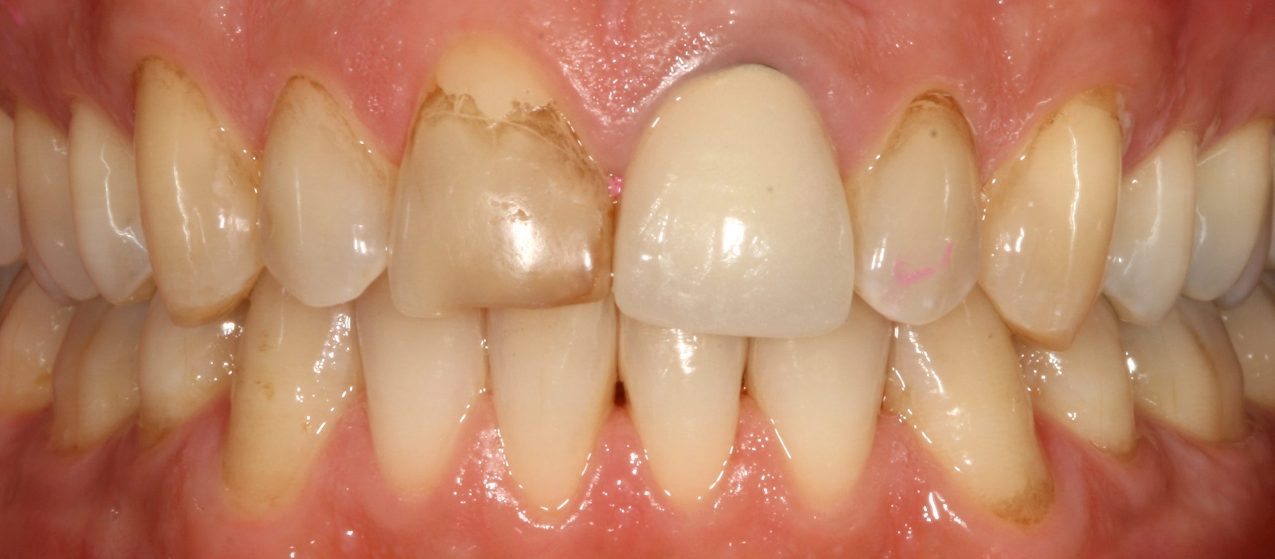 aesthetic case 3 (heavy staining) - before