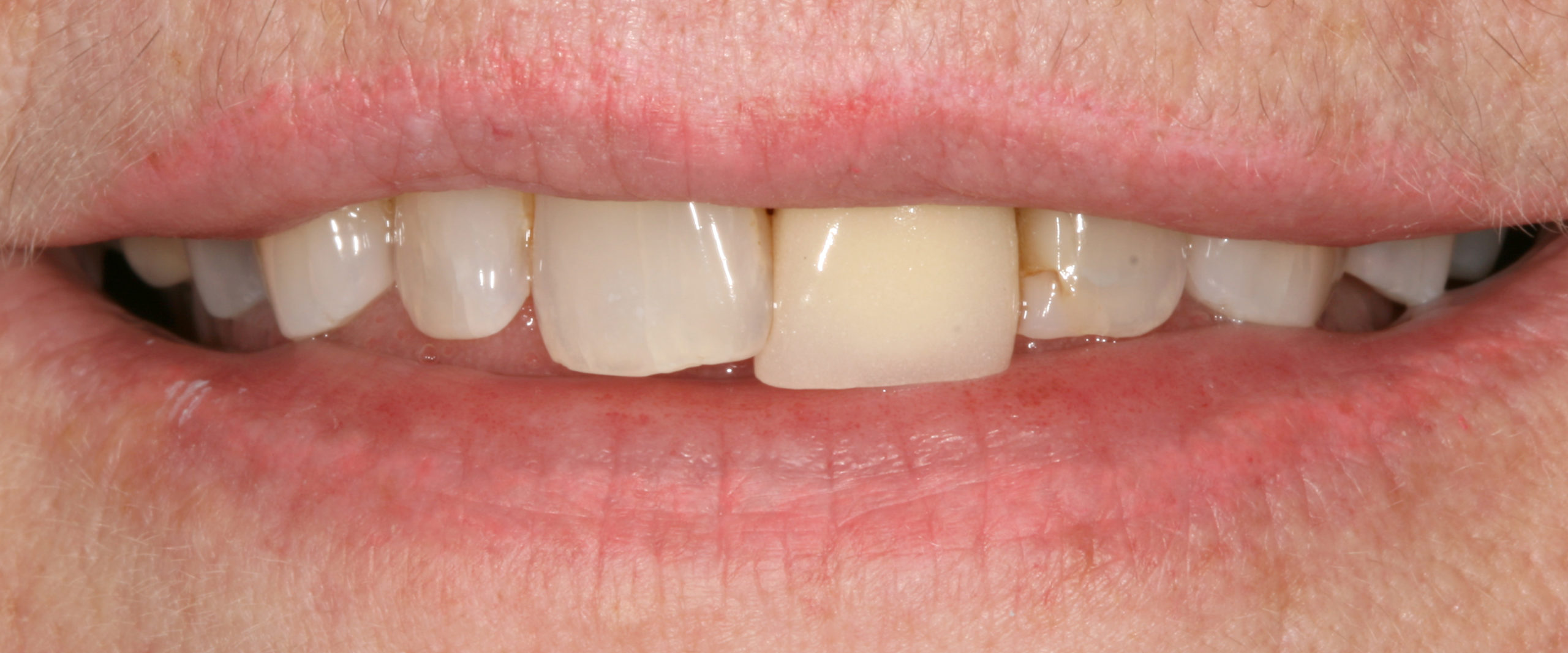 aesthetic case 4 (porcelain/metal crown replacement) - before
