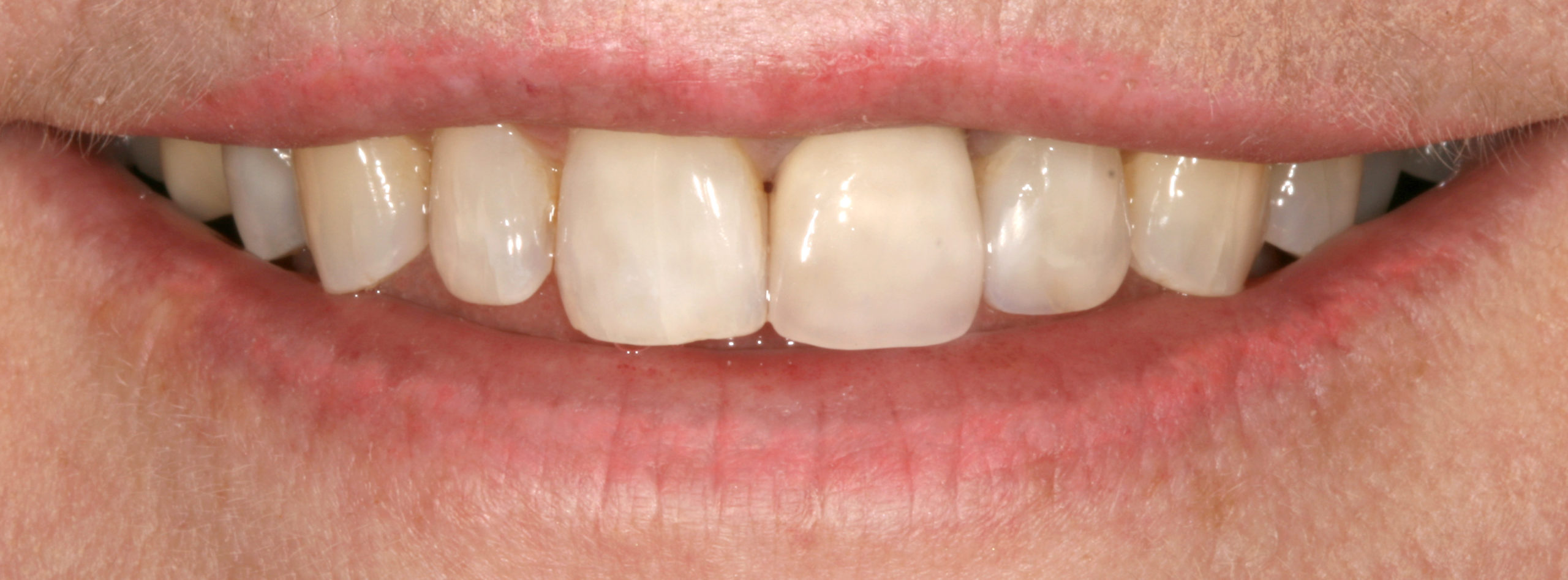 aesthetic case 4 (porcelain/metal crown replacement) - after