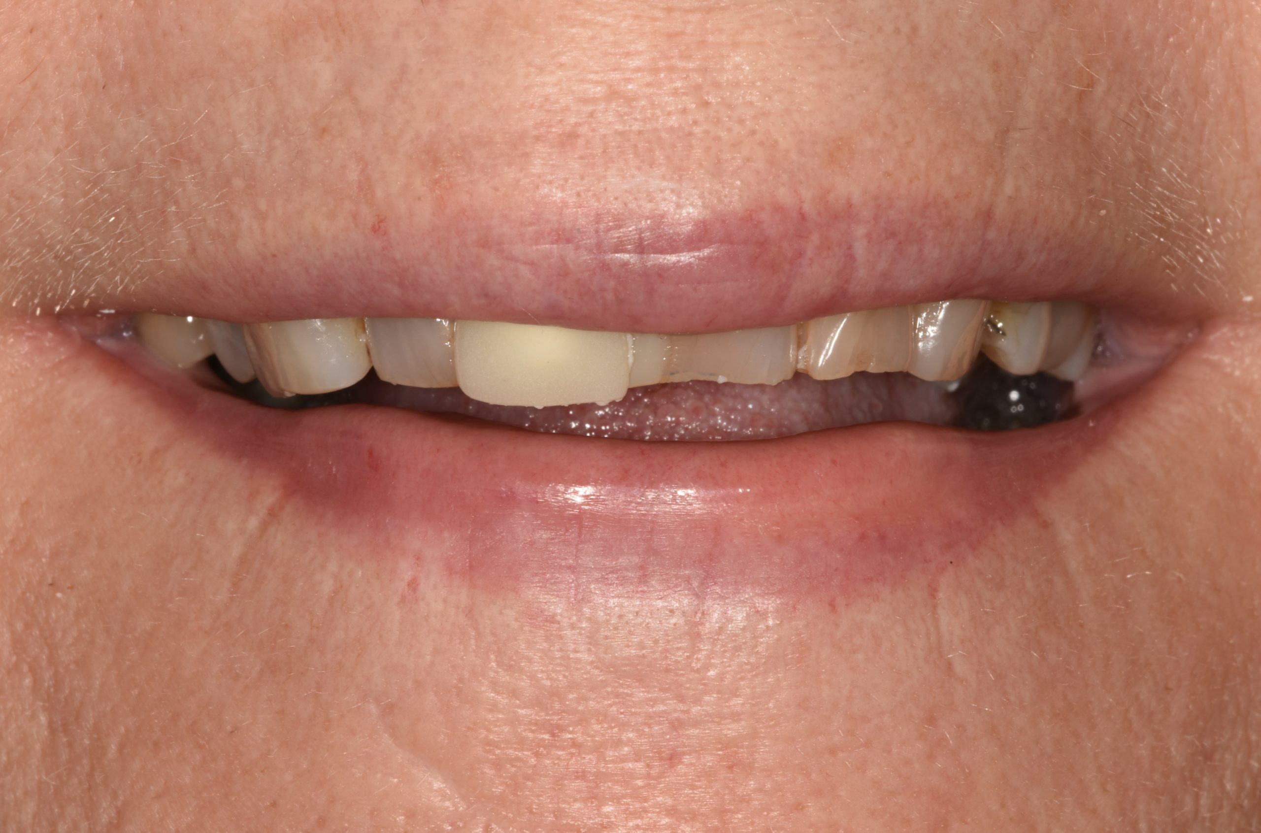 aesthetic case 5 (upper teeth) - before
